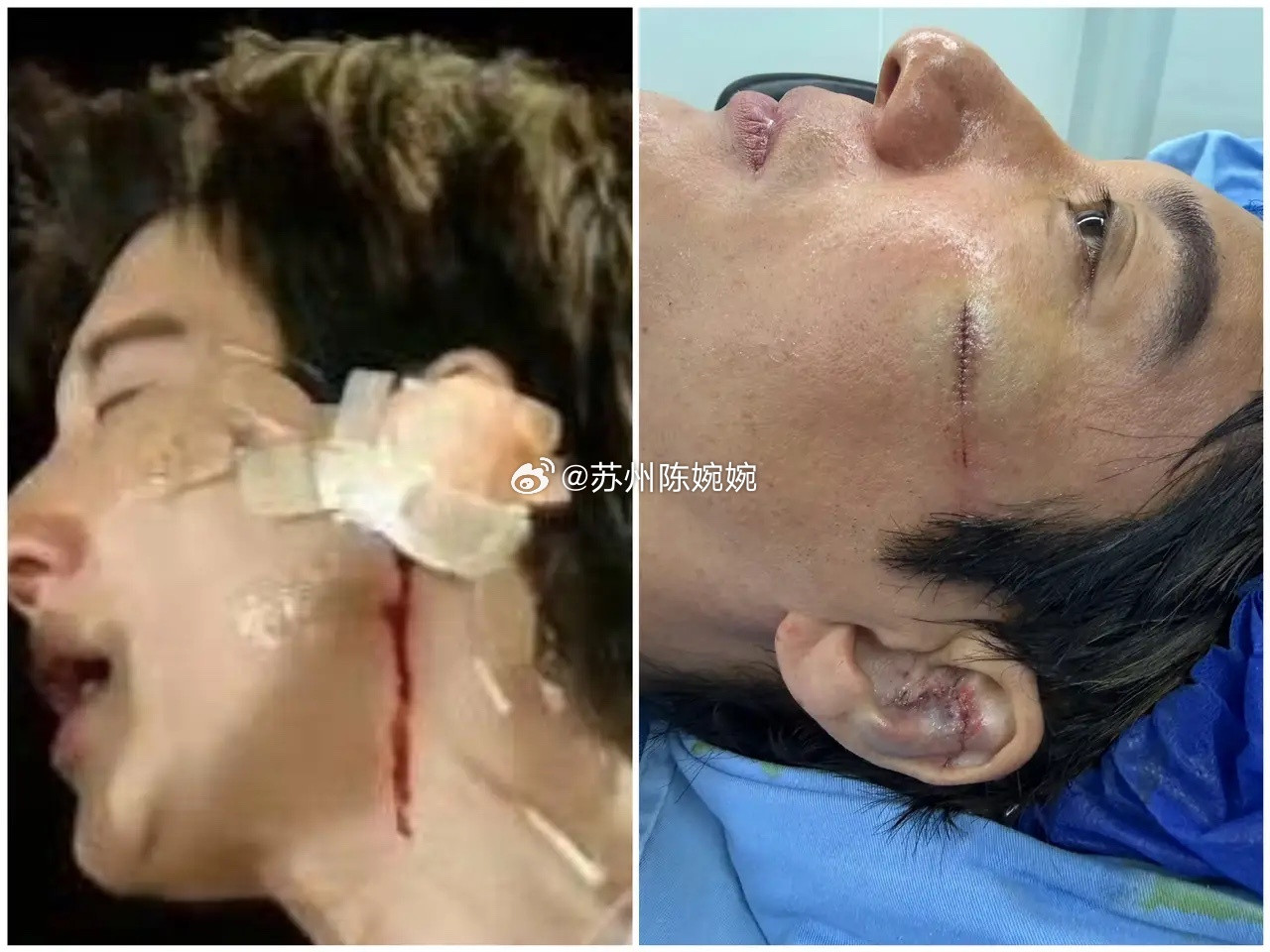 真是外行看热闹，内行看门道！我朋友是医生，他说王力宏演唱会绊倒磕伤耳朵，看着只是