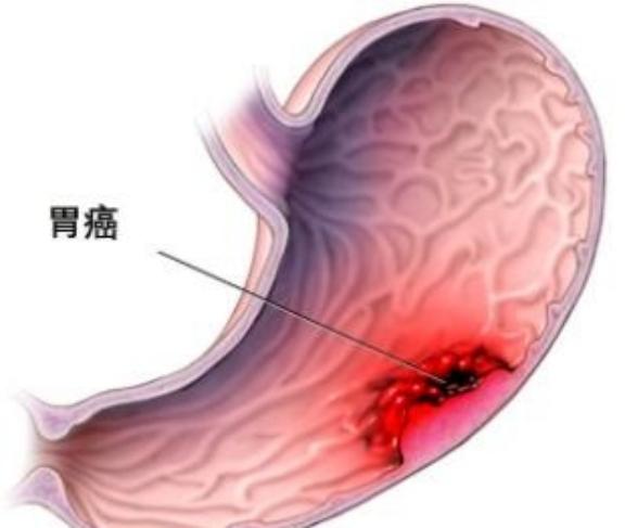 55岁女子，确诊胃癌晚期。不想拖累家人，就偷偷买了老鼠药吃。然而一天过去了，女子