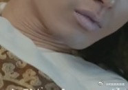 给脖子来个热玛吉。脖子最透露真实年龄了。