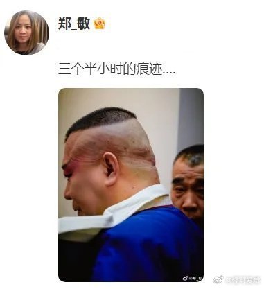 郑敏，岳云鹏的妻子，分享郭德纲刚唱完戏，卸妆下来，头皮上刀刻一般深深的印迹​​