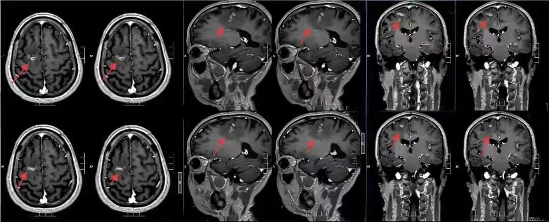 广东一男子20多年不敢一个人出门，医生从他脑中取出10厘米活虫近日，广东一名