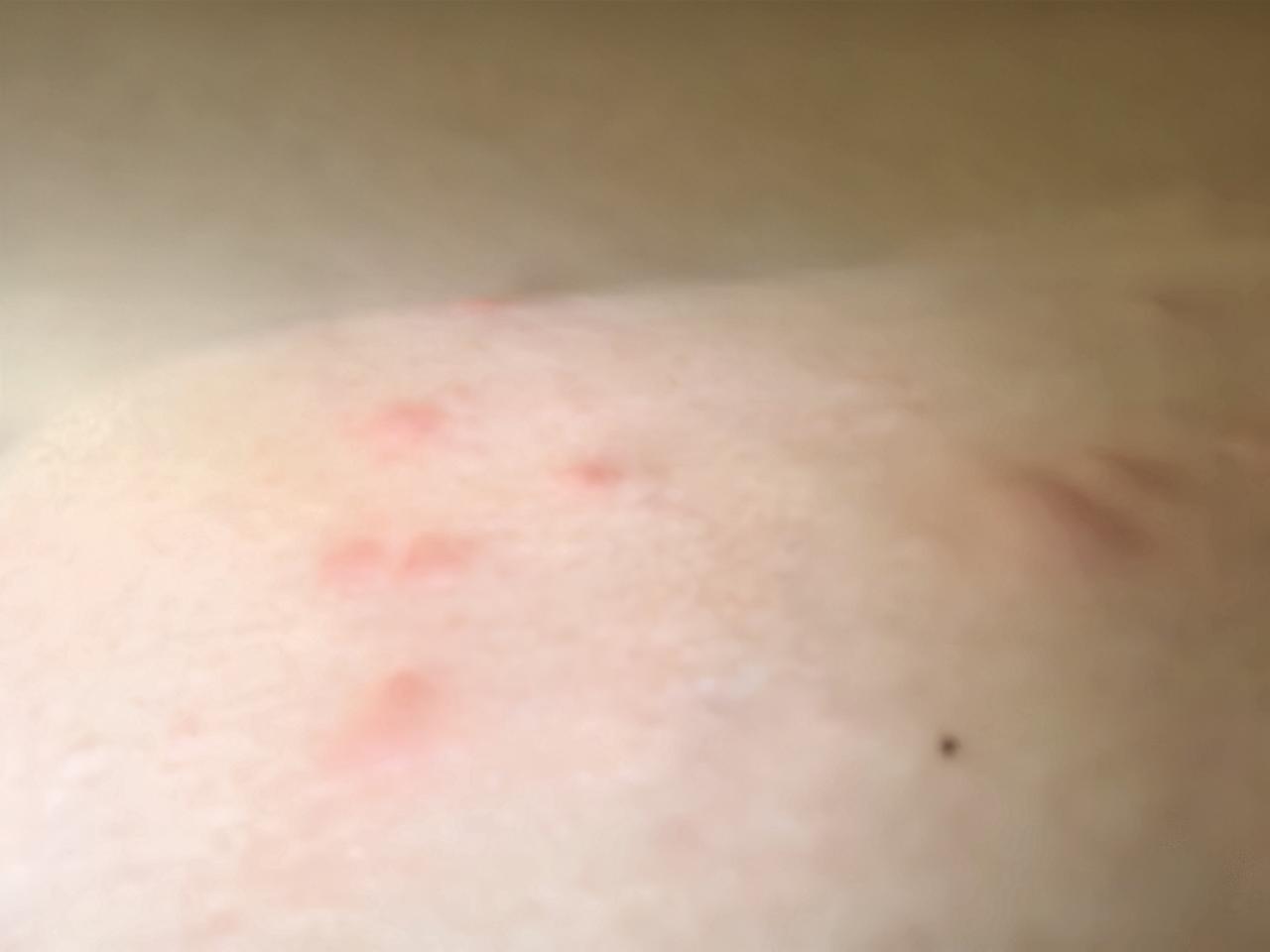 你中招了吗？种菜不成反遭罪，下地劳作被蚊虫叮咬后，我患上了虫咬性皮炎。起初只有