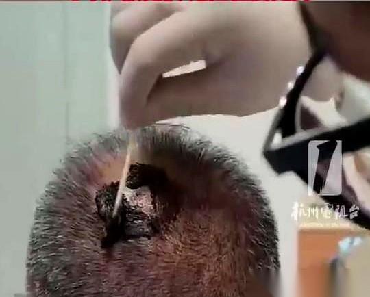 草帽刚往头上一扣，后脑勺就像被两根烧红的钢针狠狠扎透。浙江绍兴的魏大伯下意识地