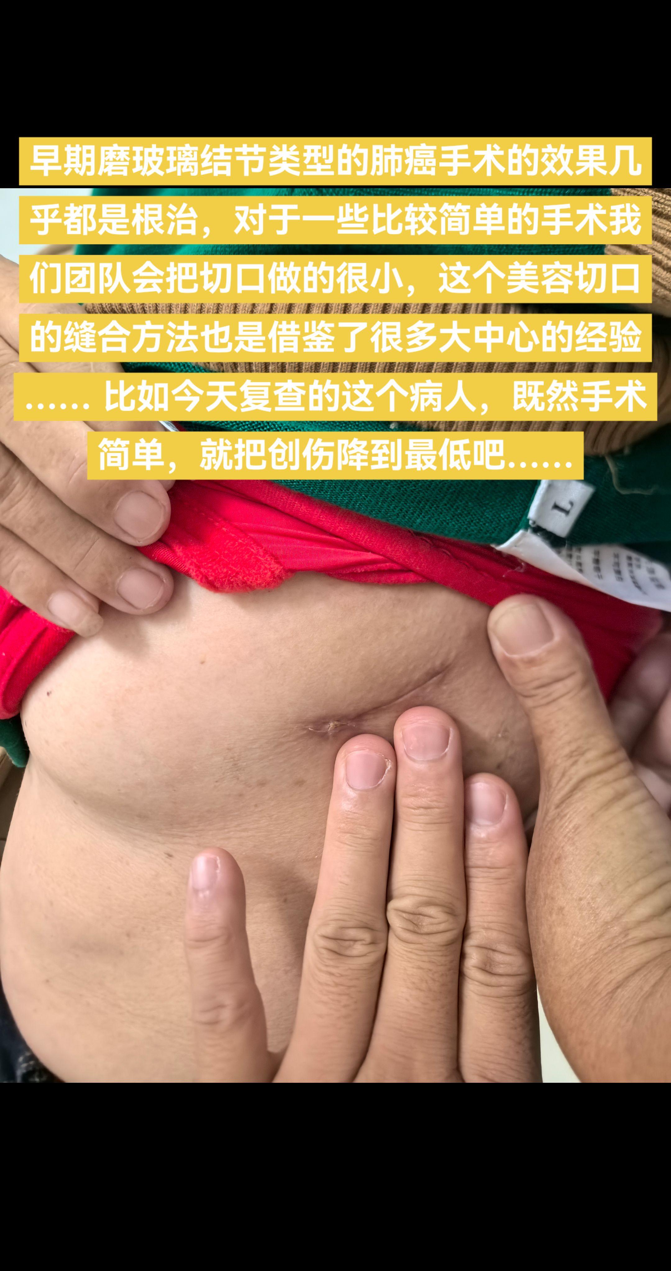 早期肺癌手术相对简单，我们也应该关注切口。早期磨玻璃结节类型的肺癌手术...