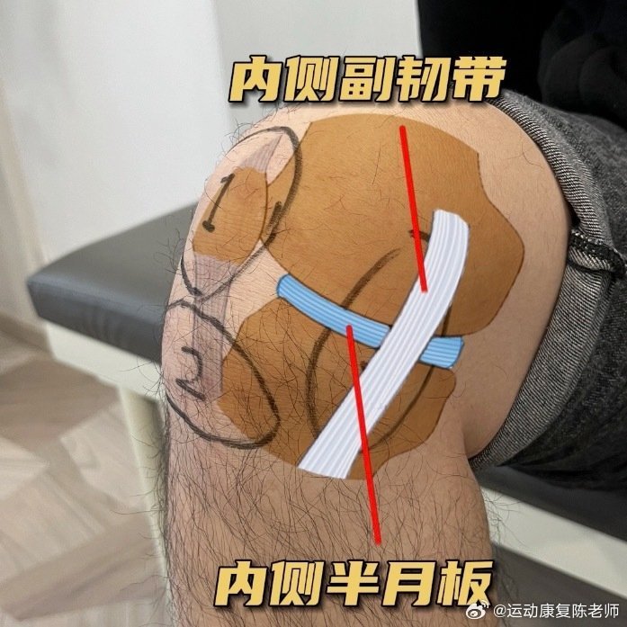 膝关节康复今天继续讲讲膝关节的损伤，这3个位置，也是膝关节最常见的疼痛区域了，