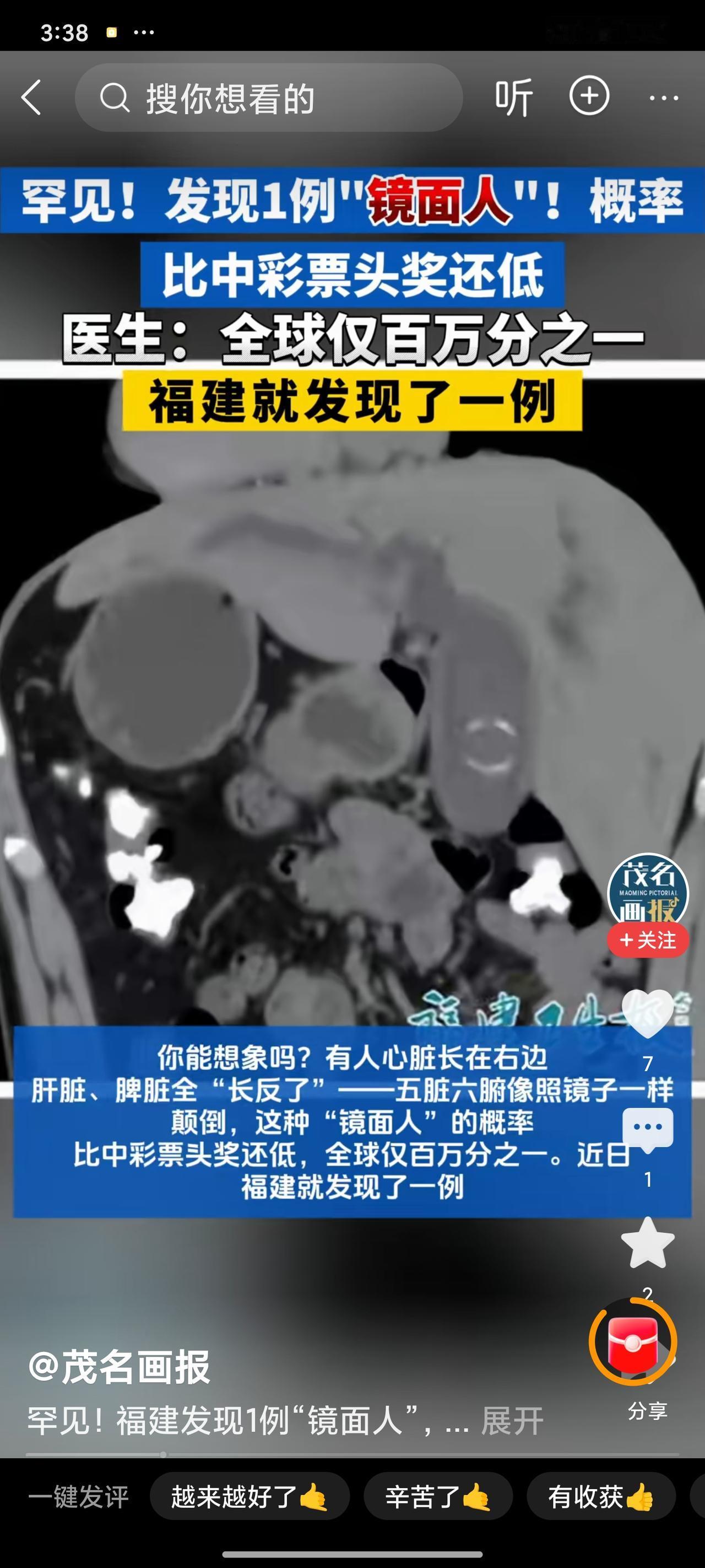 活久见！福建男子腹痛就医，竟查出“镜面内脏”，百万分之一概率+医生逆天手术看呆网