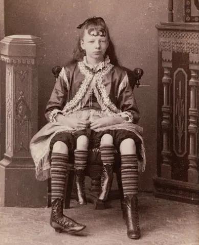 1868年，出生时就有4条腿，还有两套生殖系统。周围的人把她当成异类，父亲甚至想