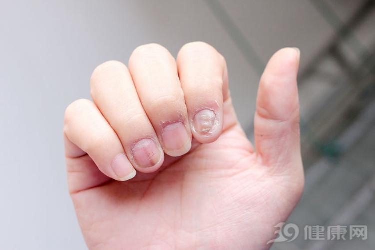 指甲上有竖纹, 我是不是身体不太好? 答案在这里!
