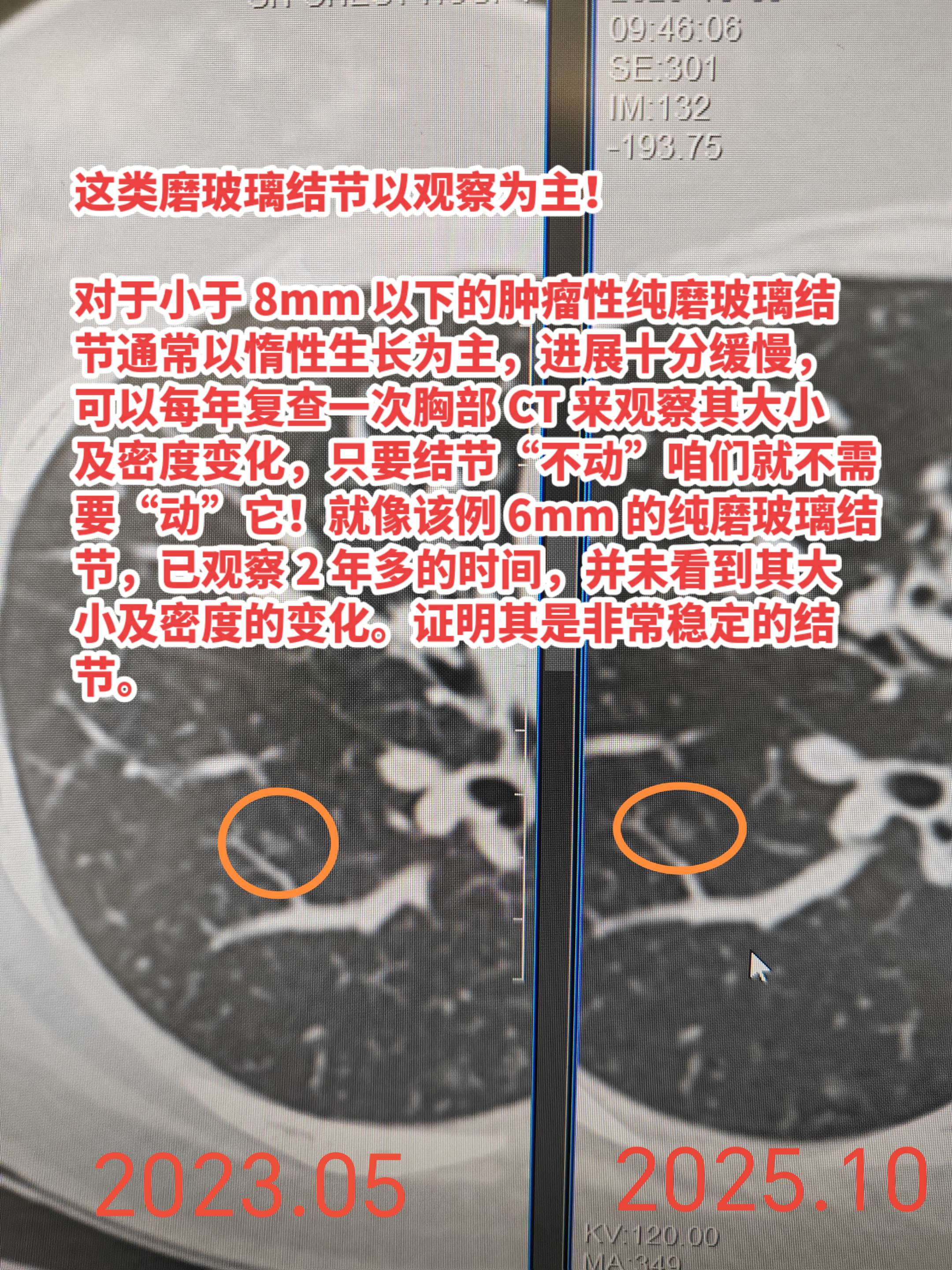 这类磨玻璃结节仅需观察！对于小于 8mm 以下的肿瘤性纯磨玻璃结节通常...