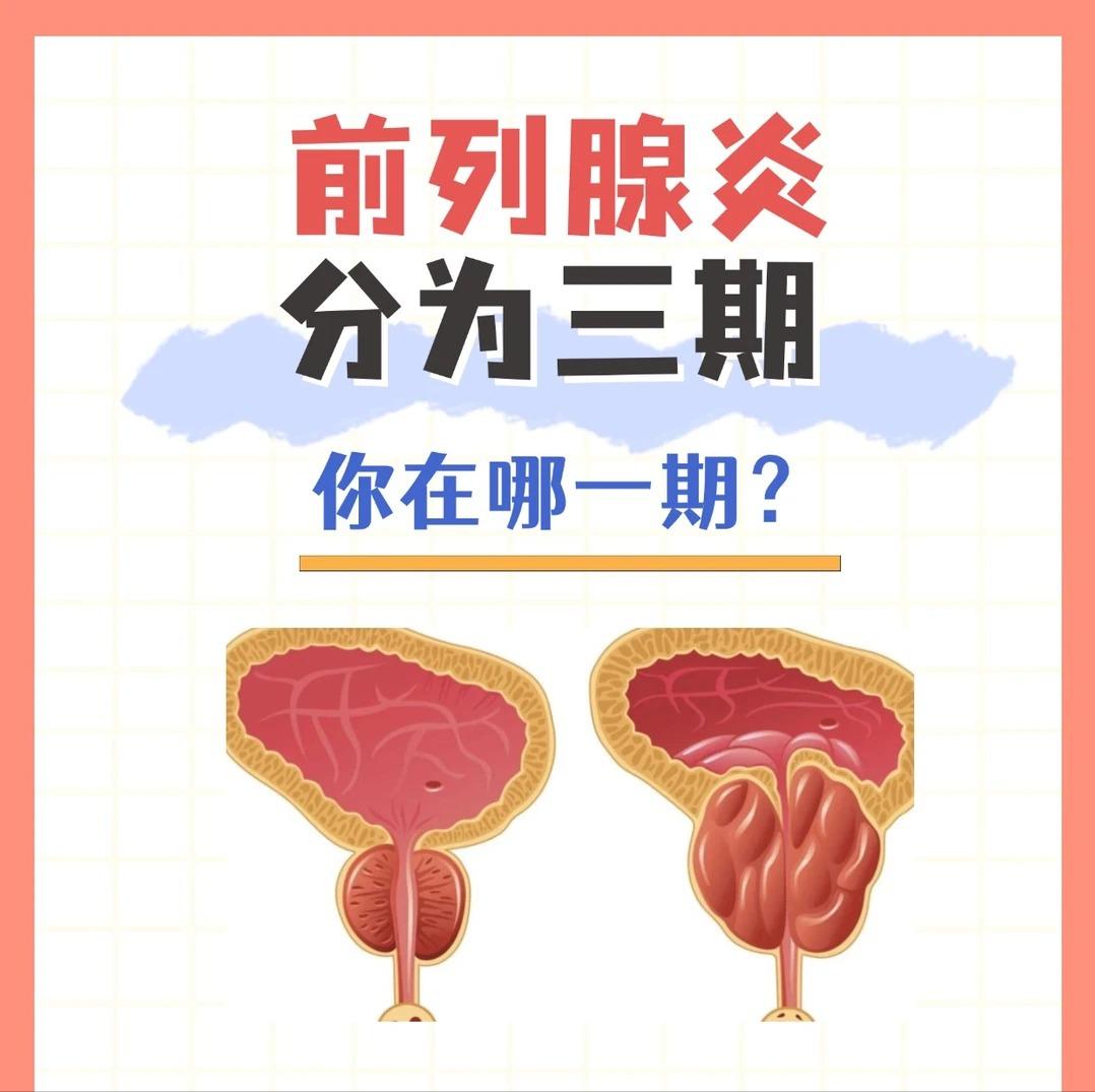 前列腺炎一般分为三期，你在哪一期？