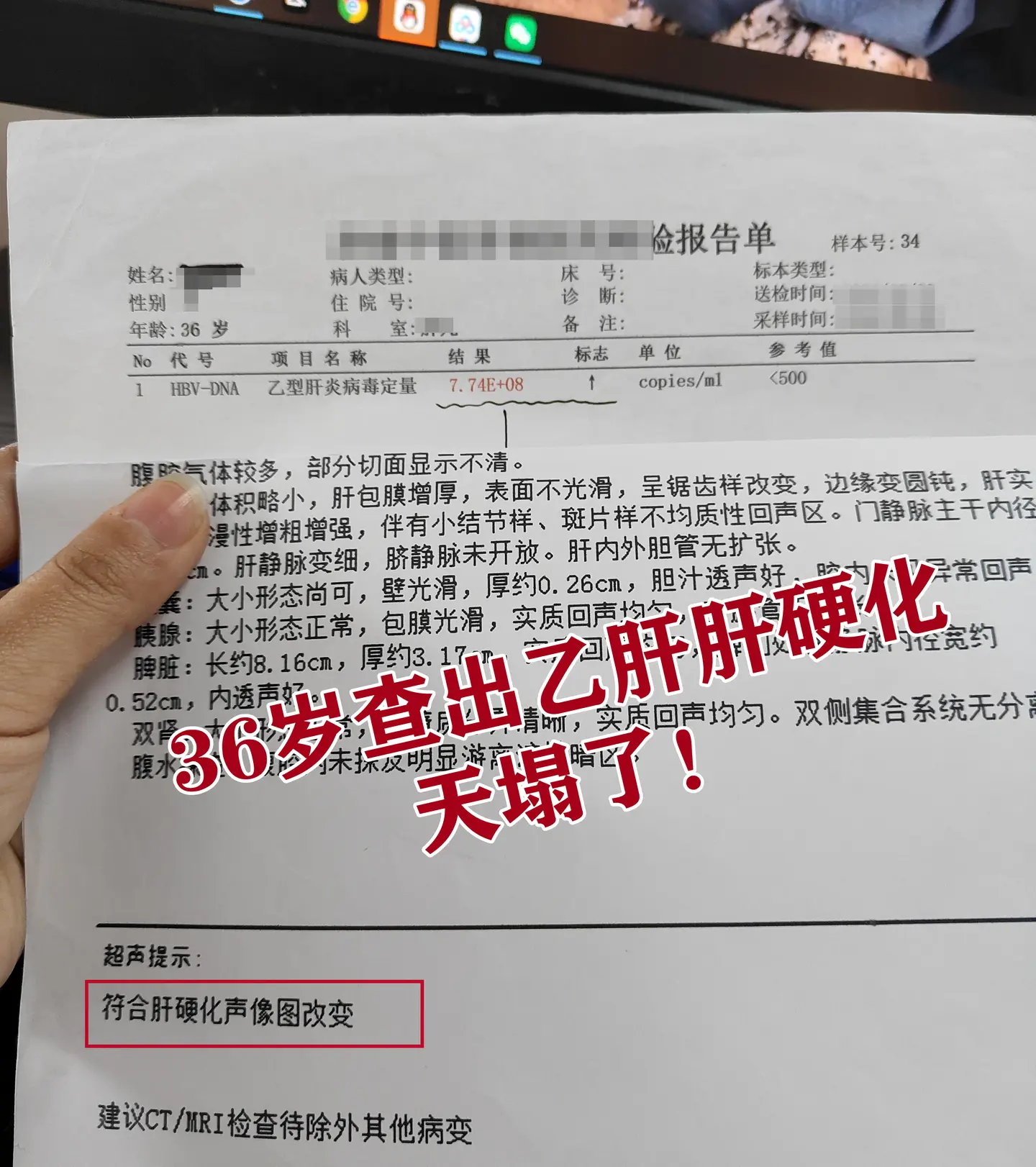 这位小伙子，你还年轻，你这种我在临床见得太多了，乙肝没你想的那么可怕。...