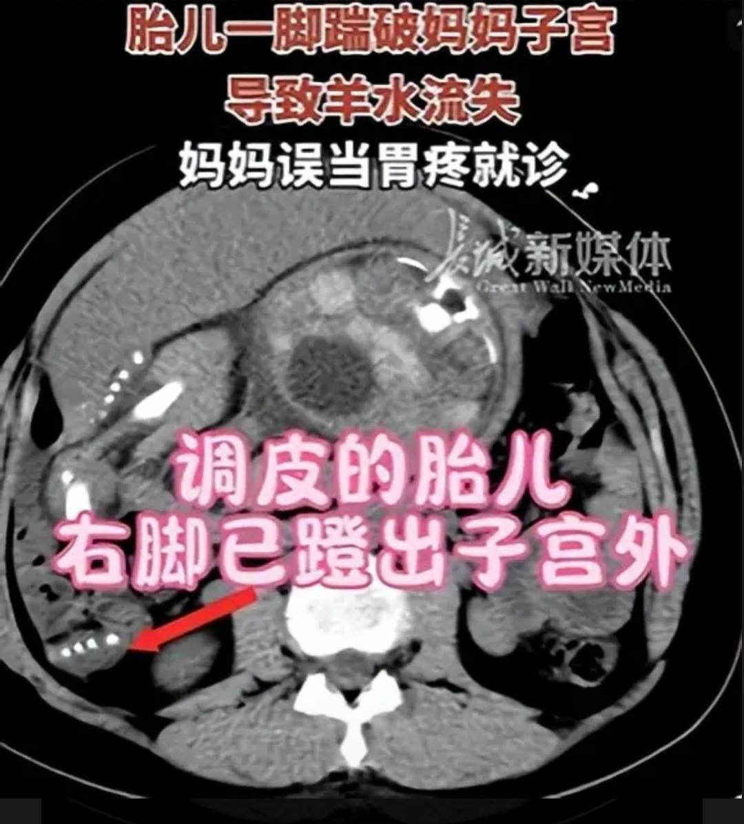 真是解释不清了现实版的“魔童降世”!近日，杭州一孕妈妈孕晚期第35周遭遇羊水