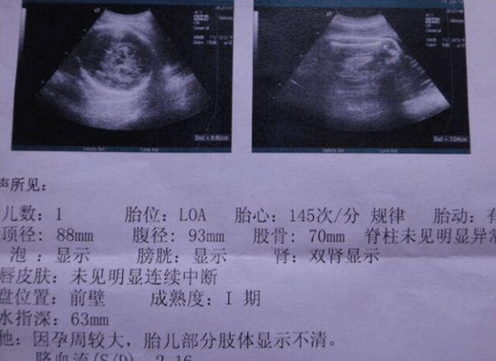 3招教你通过B超单就能判断胎儿性别