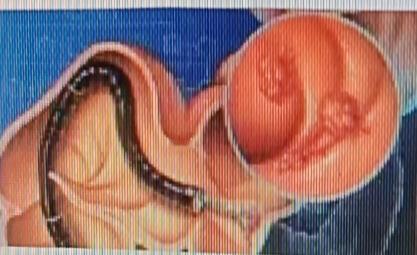 专家建议，出现这些情况就该考虑做肠镜。要是大便习惯突然改变，比如原本规律的排便变