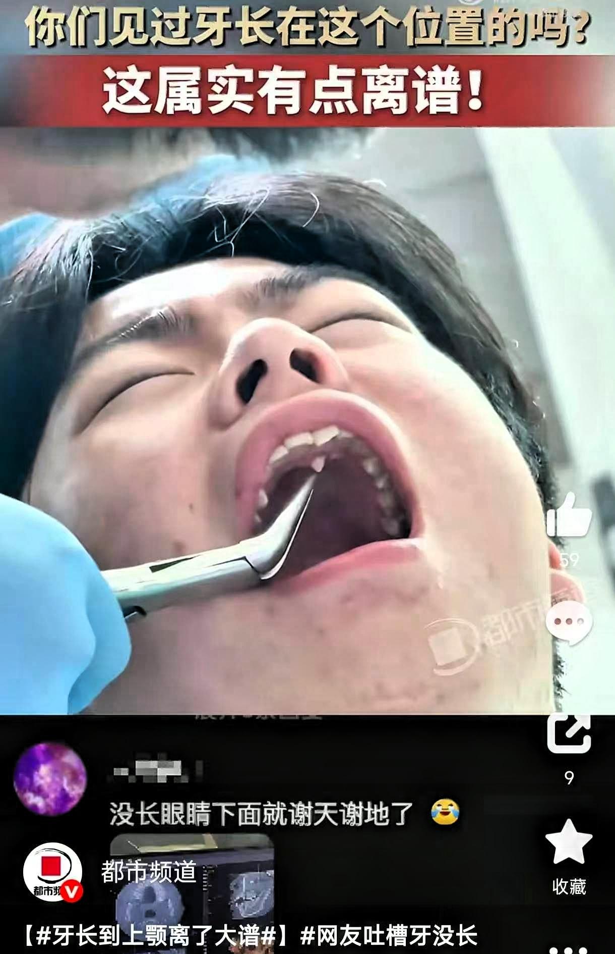 笑不活了！河北，一小伙因为牙疼去牙科拔牙，结果医生检查时发现，他的牙齿竟然长在了