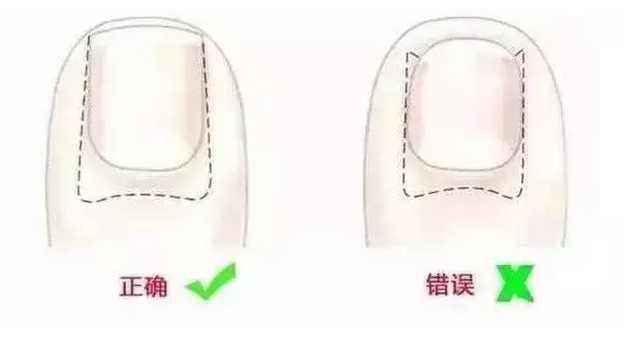 乱给孩子剪指甲后果很严重