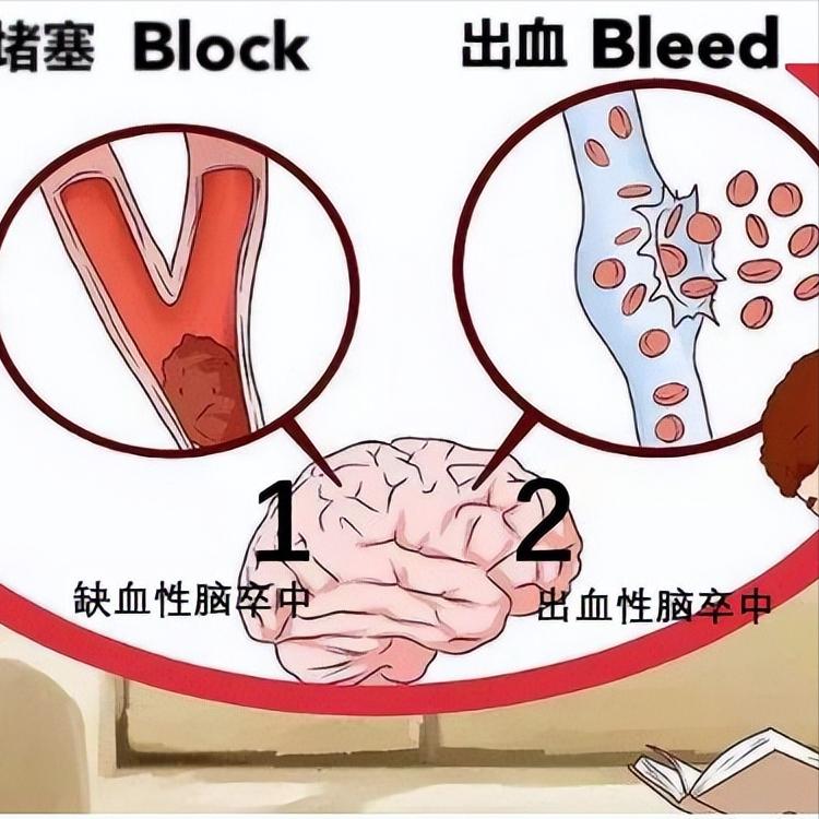 脑梗背后竟然是情绪在捣乱，当心这2种情绪！1.情绪突然爆发研究表明，情绪的