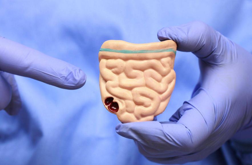 肠癌“源头”已发现，油炸没上榜，第一种很多人每天都在吃！很多人以为，肠癌的