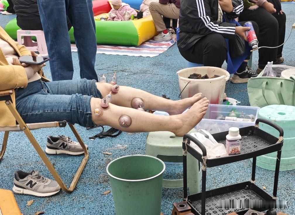 江湖郎中先拔罐一顿拔然后死血后，一顿扎针再接着拔就会拔出血液和体液然后