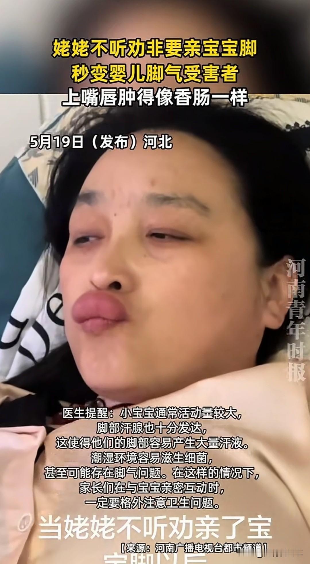 亲吻后半小时嘴唇开始发痒红肿，几小时内迅速肿胀变形，送到医院检查结果让全家都愣住
