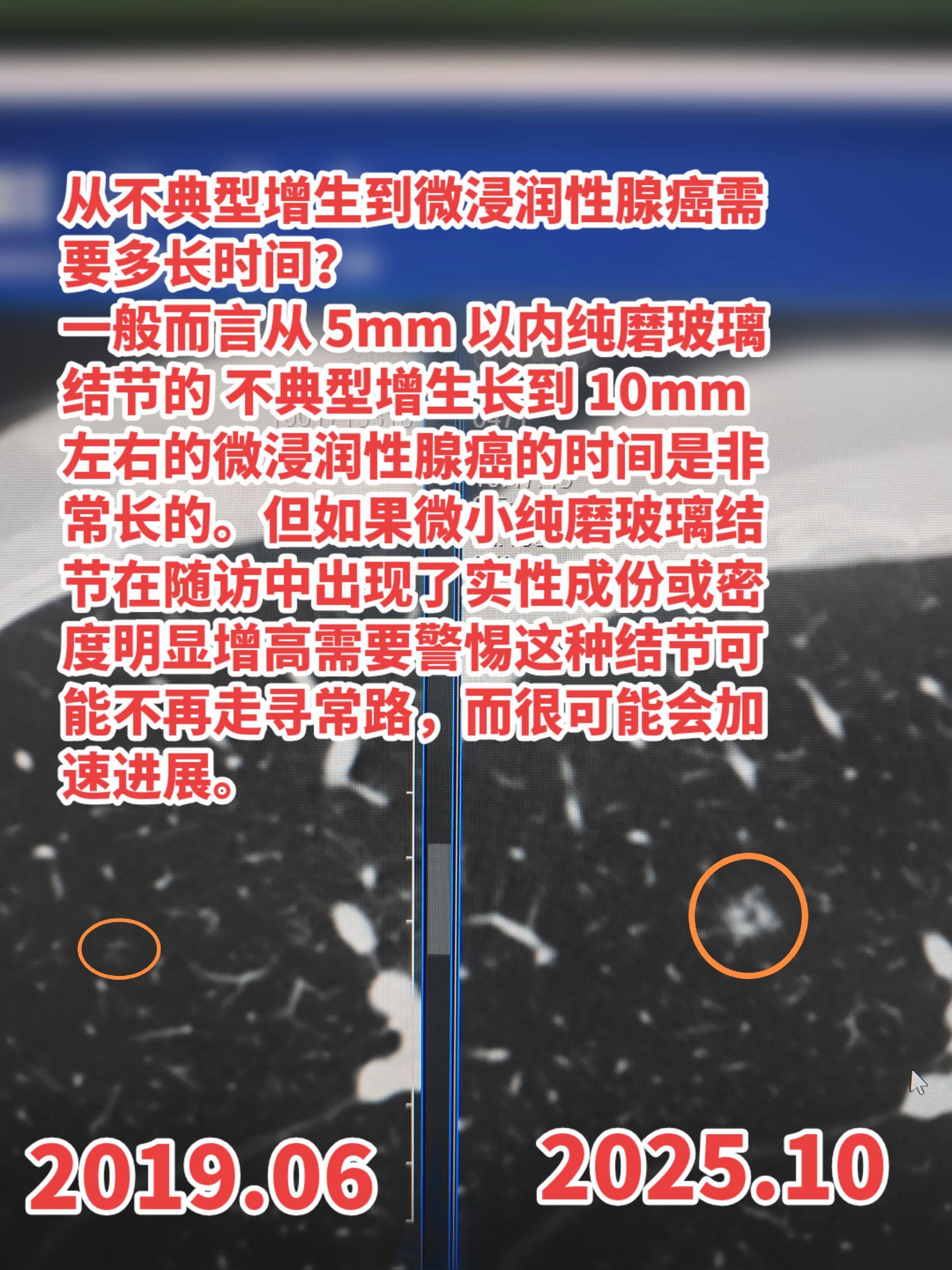 从不典型增生到微浸润性腺癌需要多长时间？一般而言从 5mm 以内纯磨玻...