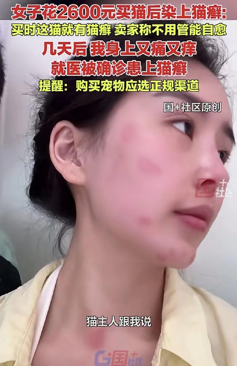 女子发布视频称自己被猫癣传染了。原来，女子买猫时，猫就已经患有猫癣，商家表示不用