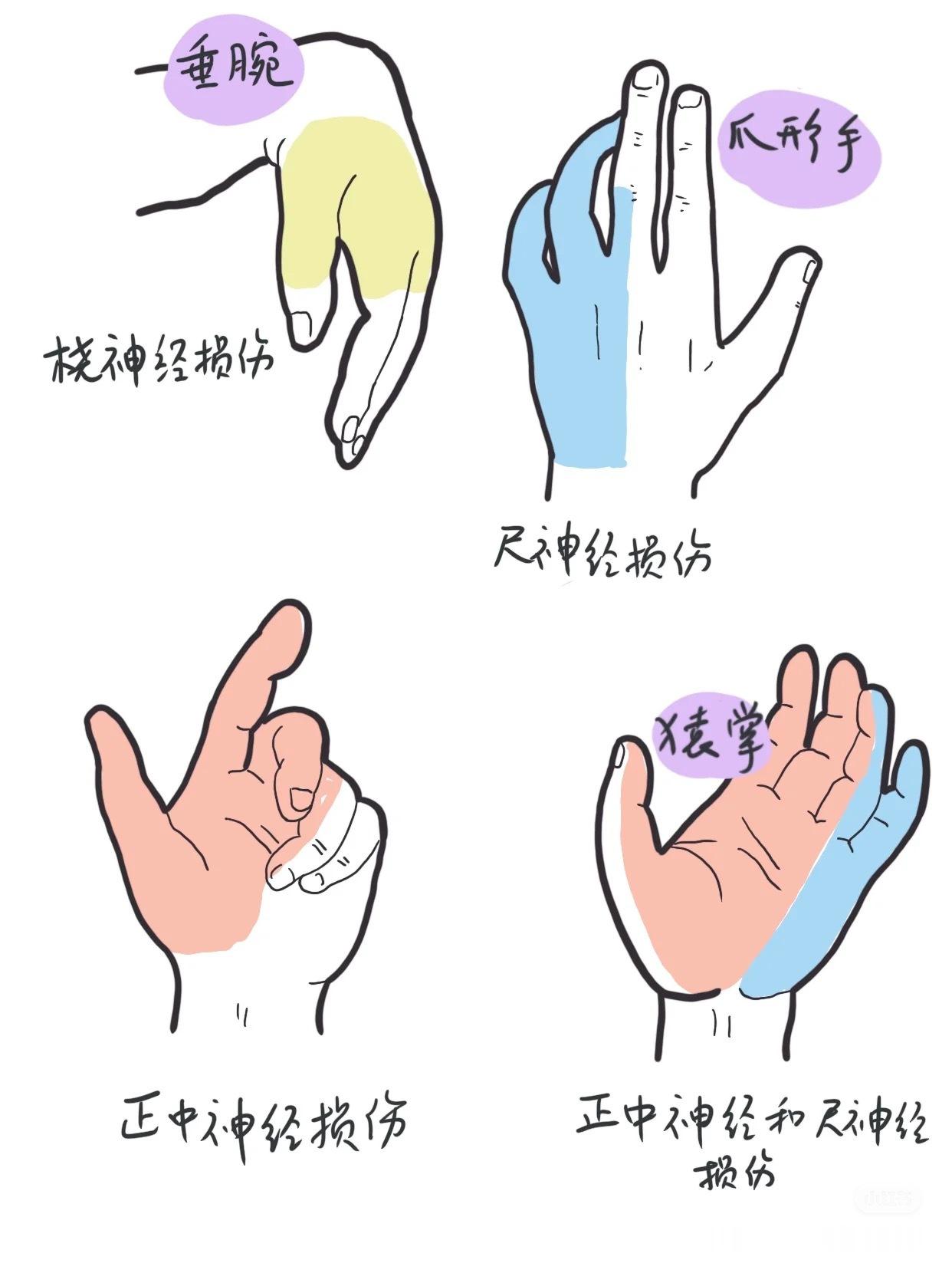 手部损伤一张图来带你了解——手部神经损伤表现，除了发麻、疼痛、无力，还会有以下