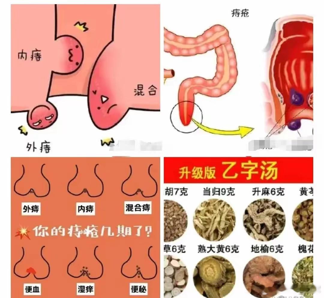 几乎没有拿不下的痔疮——乙字汤乙字汤是治疗各种痔疮、大便燥结等疾病的汤药。出自