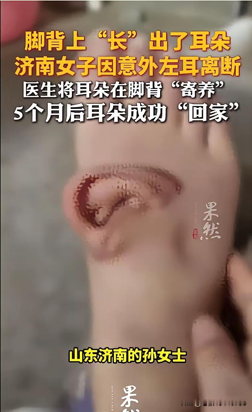 耳朵因事故断离能培养再植成功，你相信吗？济南一患者因事故一则头皮连耳朵一起断
