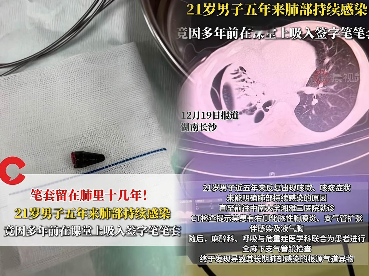 “心大”起来真要命！湖南长沙一21岁男子反复咳嗽五年，各种吃药都不见好，去医院