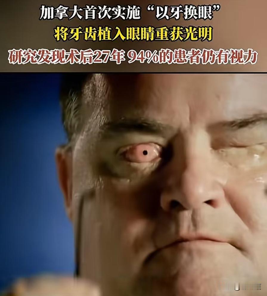 “以牙换眼”技术大获成功！意味着今后只需拔下一颗牙，把它种到眼睛里，就能让无数盲