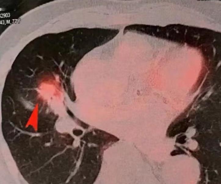 PET-CT做一次要花近万块，为什么这么贵？普通人有没有必要做？今天我们就来聊聊