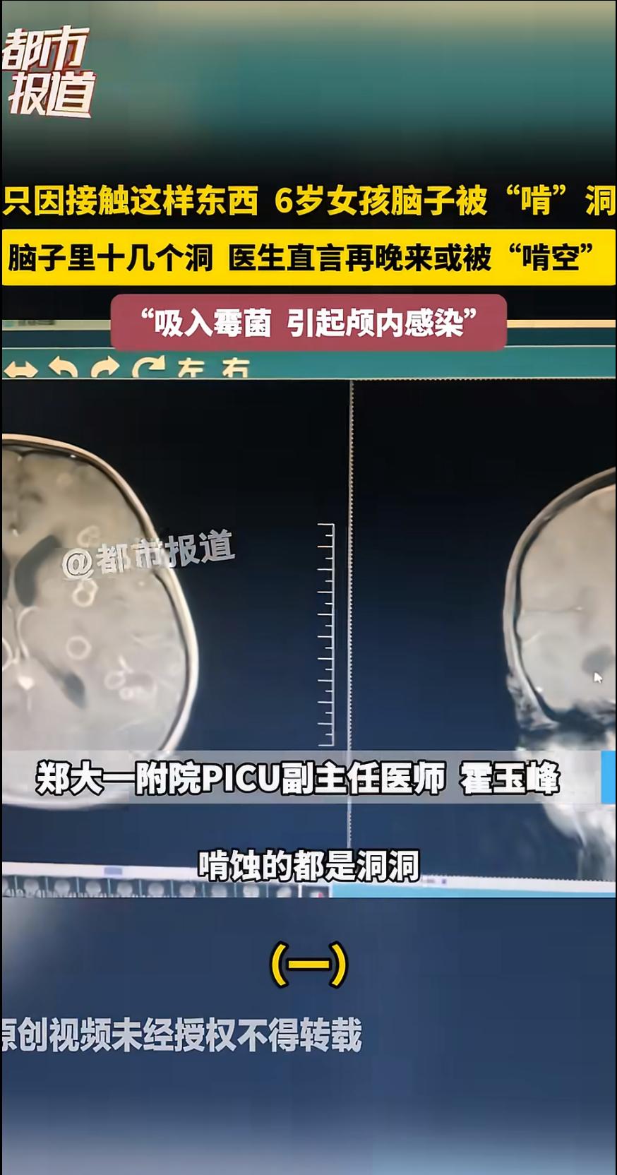 河南一名6岁女童持续发烧17天，辗转多家医院后确诊化脓性脑膜炎，颅内感染严重到可