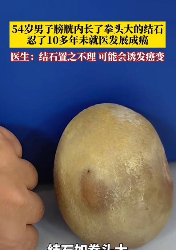 “悲剧还是发生了！”5月26日报道，广西，一男子在过去十多年，就出现尿痛及排尿不
