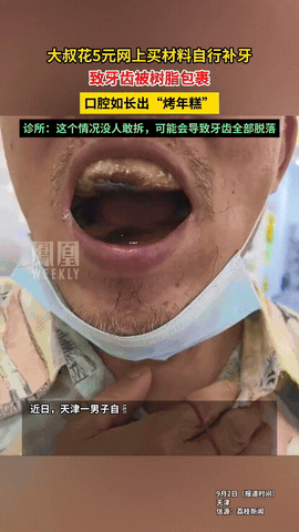 “这下造成悲剧了！”天津，一男子舍不得花钱补牙，于是就买了五元的树脂，自己把牙齿
