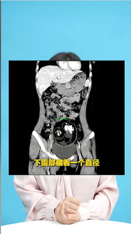 “太吓人了！”近日，湖南长沙，一女生在家跳操后突然感觉腹痛难忍，赶紧到医院做了检