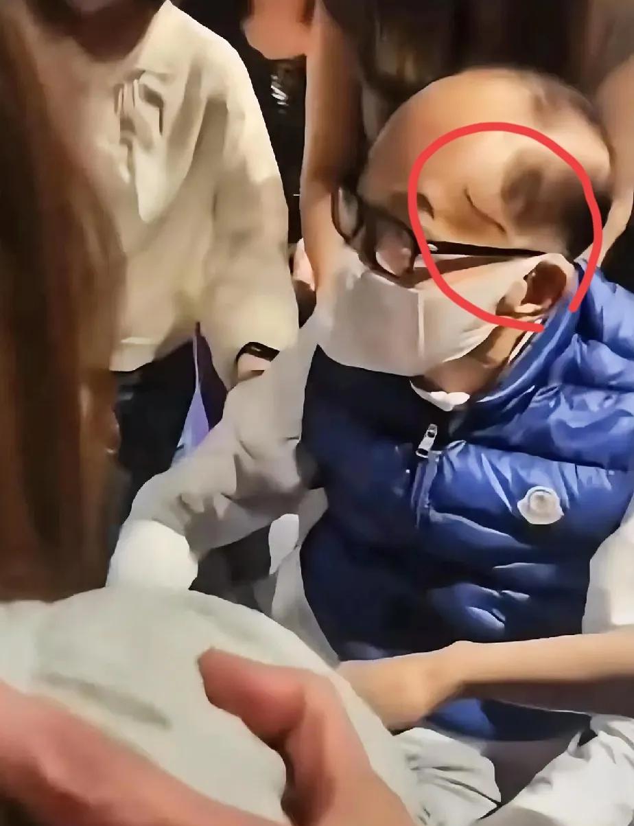 李嘉诚头上是什么东西？蚯蚓一样的，这么长一条，看着也不像疤痕。