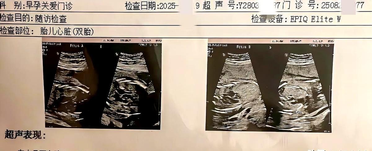 太意外了我老婆怀了双胞胎！这次真的是意外怀孕了，我老婆已经44岁了，还是双胞胎