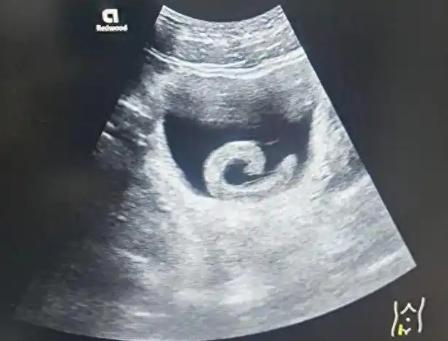 太离谱了！河南郑州，一男子听信“偏方”，将5厘米的水蛭塞进尿道，水蛭顺着尿道向内