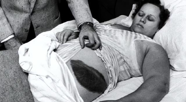 1954年，国外一女子正在睡觉中，突然感觉腹部和大腿被什么东西蹭着了一样，疼痛难