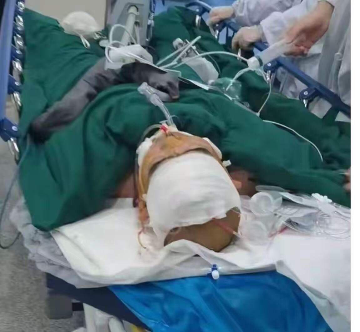 湖北十堰，公司食堂误把工业酒精当散酒，3个员工下班聚餐后一个抢救无效死亡，一个脑