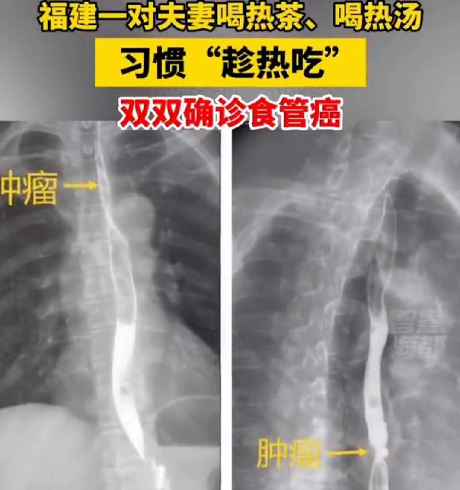 趁热吃，不一定是个好习惯。如果太烫了，就会惹来疾病。福建泉州的徐先生，今年56