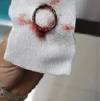 甘肃女子取环术后入ICU医院承认操作不规范并致歉甘肃天水28岁女子白女士