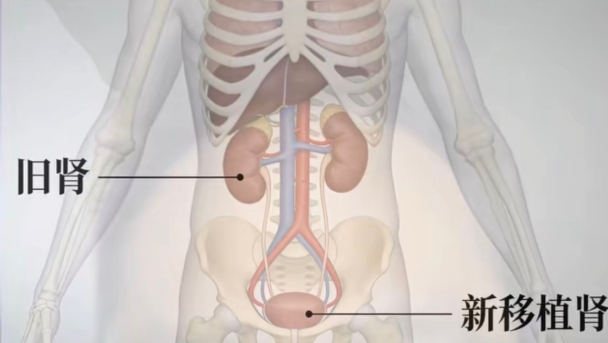 换肾原来是加一个肾进去，旧（坏）的还在肚子里，哇趣真是冷知识了