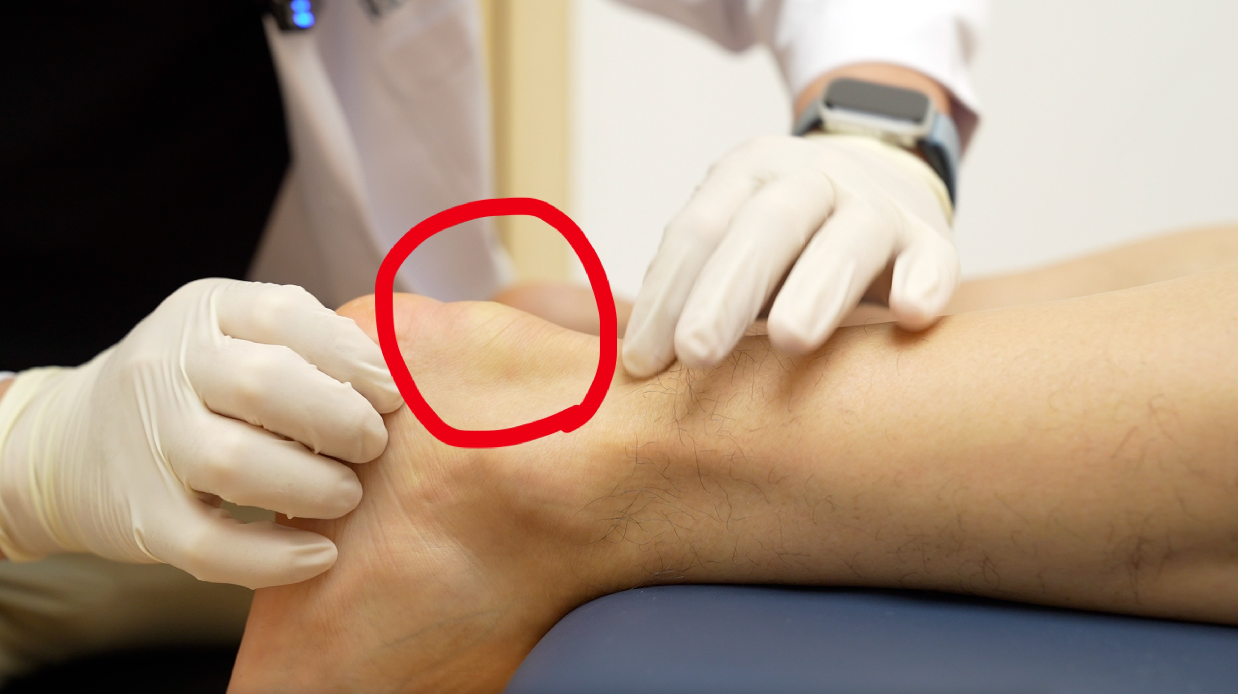 前两天在北京国贸店，评估了一位大哥，爱好跑步，也跑了十几年的马拉松，后来跟腱位置