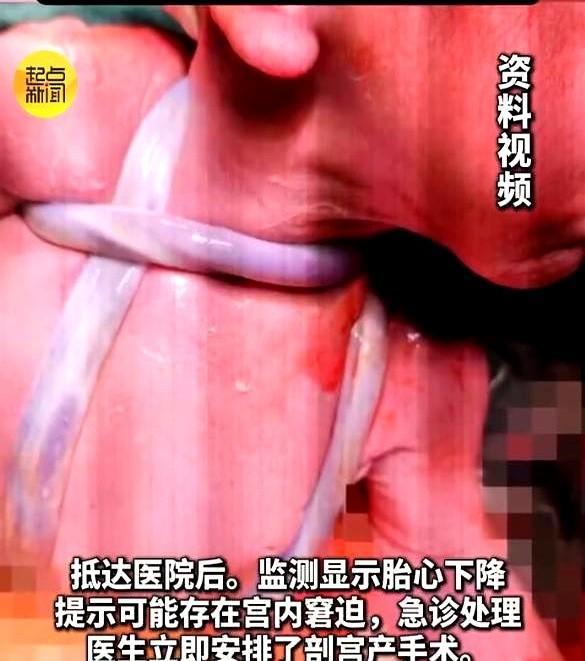 陕西一怀孕的38周孕妈感觉到自己肚里的胎儿4个小时内只动了一次，她怀疑孩子可能有