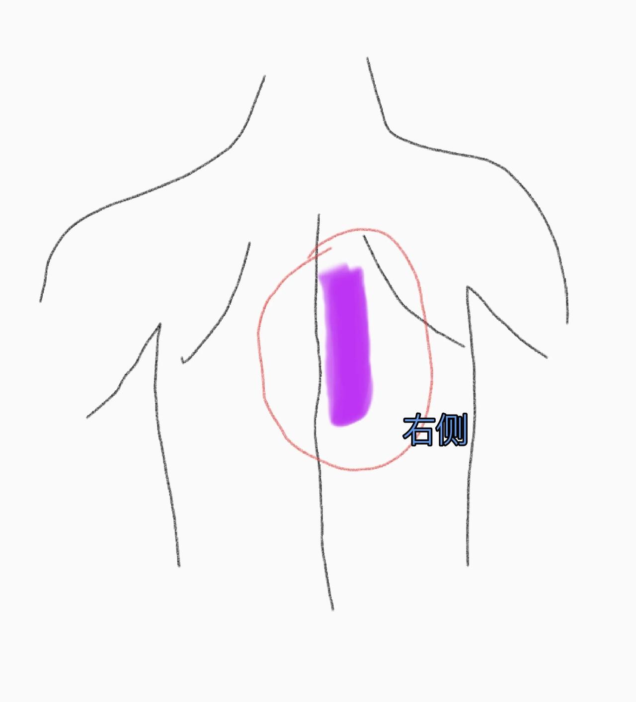 后背这个位置疼怎么回事后背右侧的这一段筋疼，有一个多月了，之前刚开始疼以为扭到