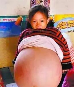2010年，山西4岁女孩胡云星，肚子超大鼓胀得像孕妇。医生预言活不过三个月，就在