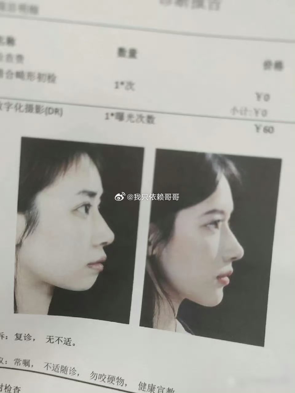 美女整牙前后对比，变化大吗？