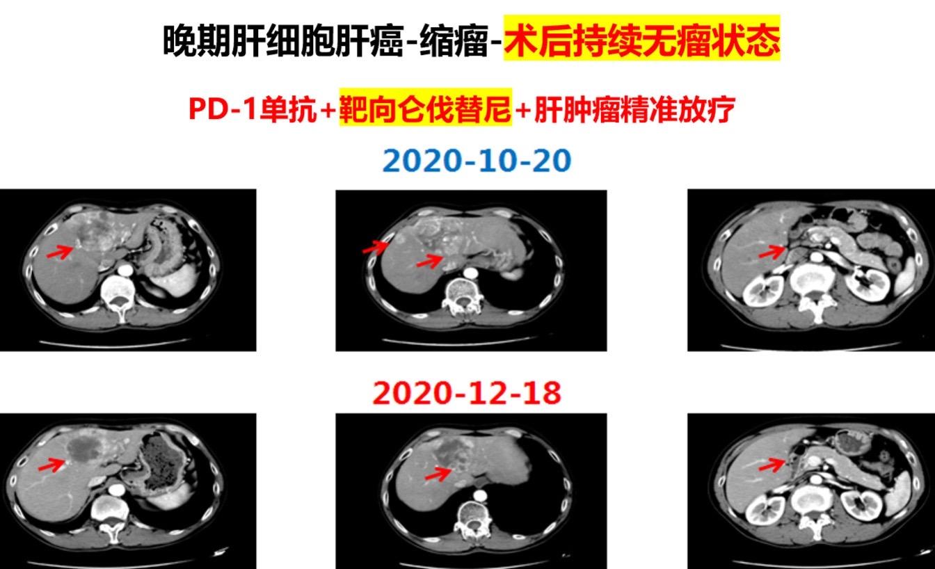 晚期肝癌的新辅助治疗-术后持续无肿瘤状态。患者男，53岁，体检发现肝脏...